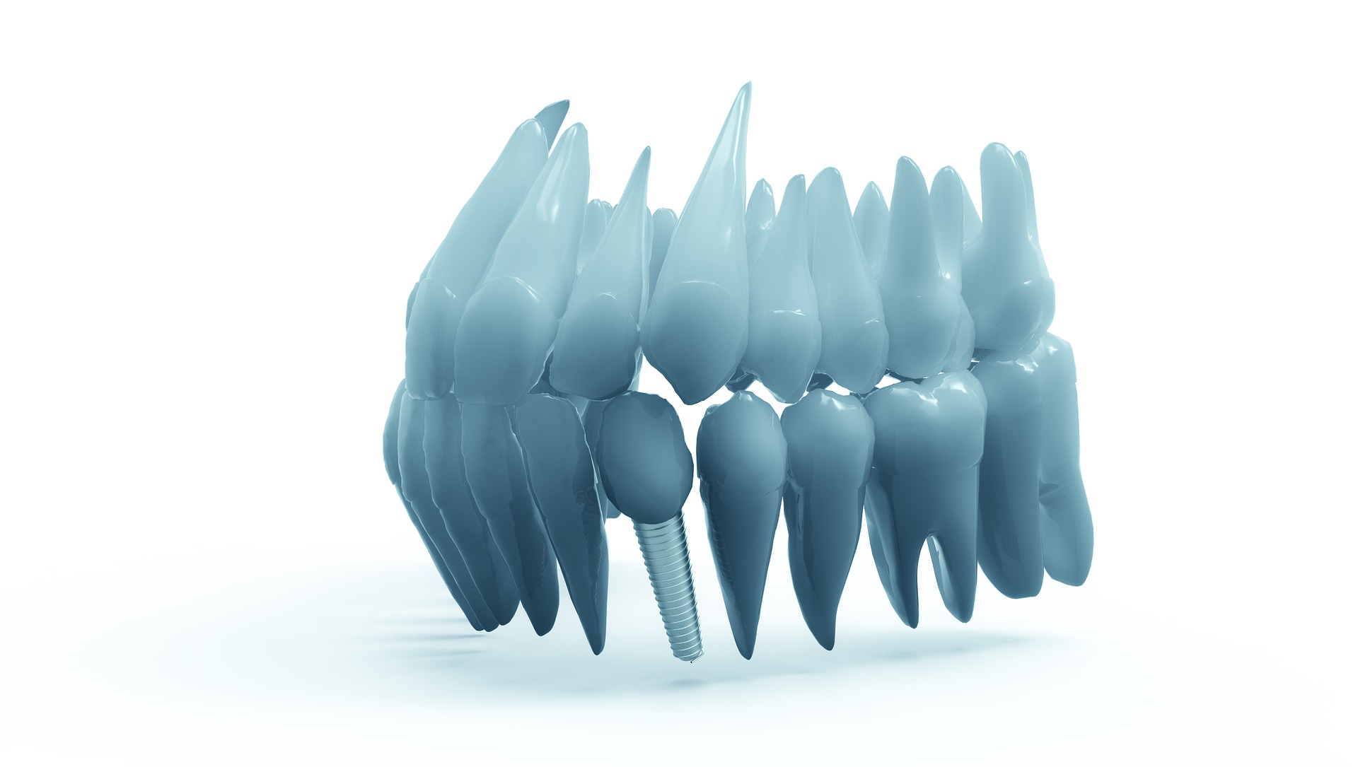 Proces zakładania implantów zębowych