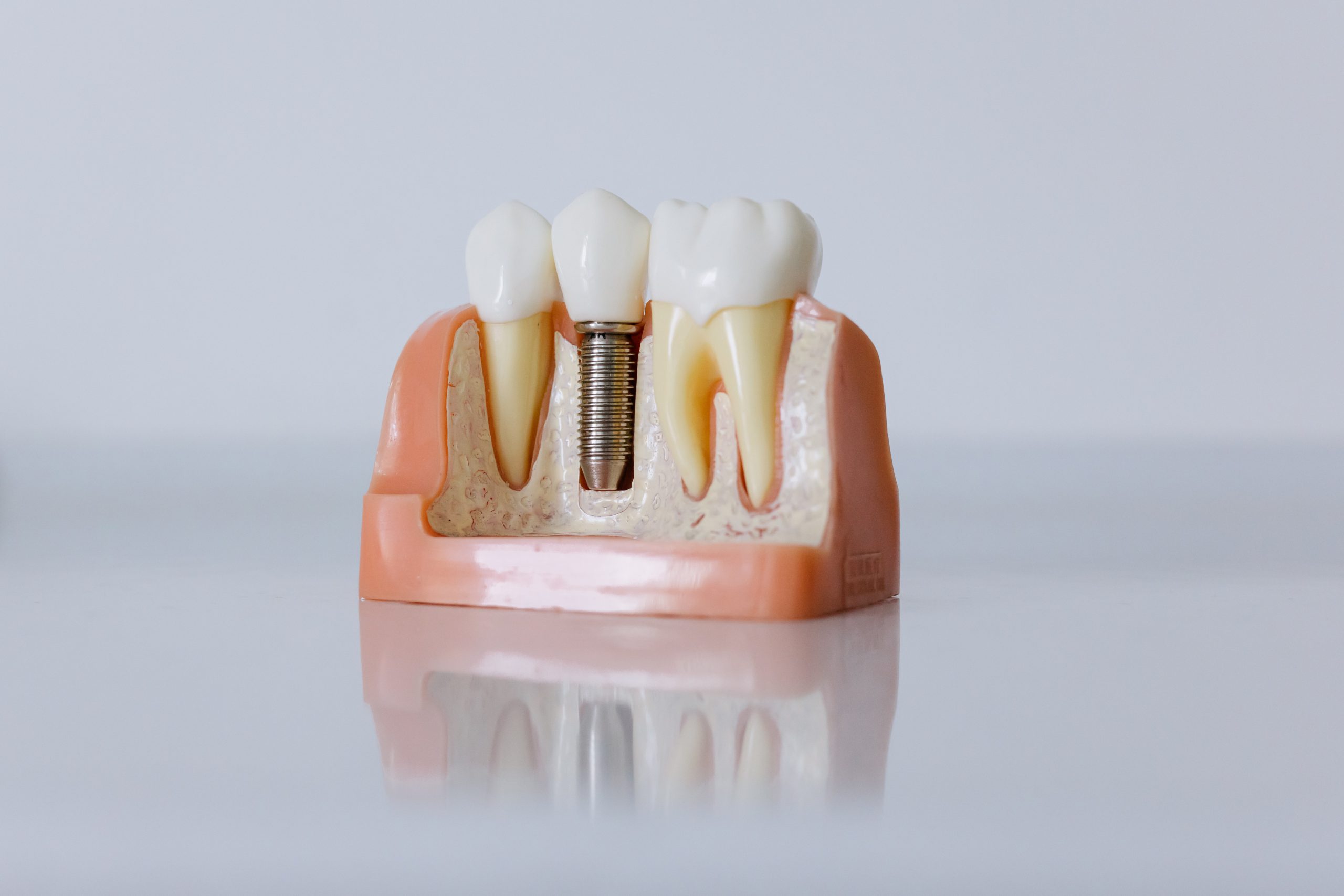 Implanty zębowe - czy warto